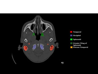 Imaging in Skull base | PPTX