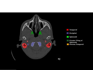 Imaging in Skull base | PPTX