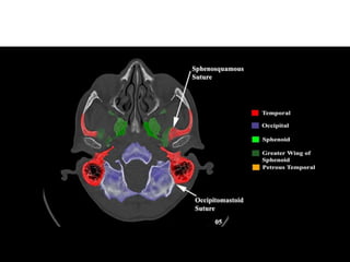 Imaging in Skull base | PPTX