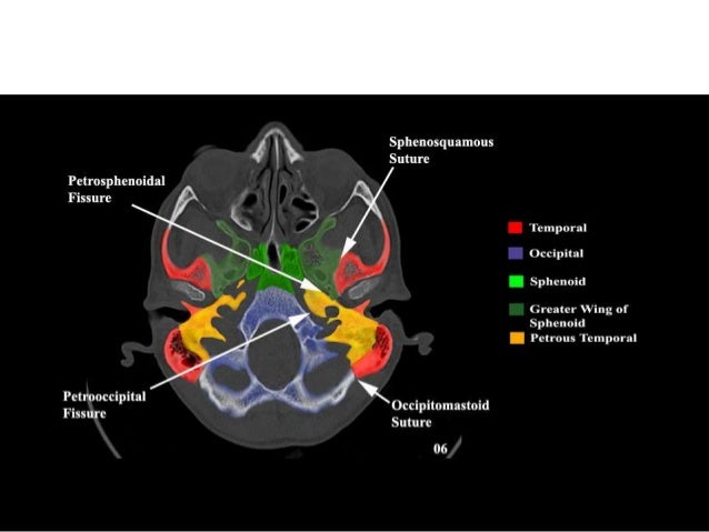 Greater And Lesser Wing Of Sphenoid Ct - slidesharetrick