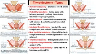 Thyroid Tumours - Malignant & Thyroidectomy | PDF