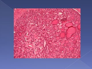 TypesPrimaryFollicular cells (papillary, follicular, and anaplastic)Para-follicular cells (medullary)Lymphocytes (lymphoma)SecondaryMetastasesLocal infiltration