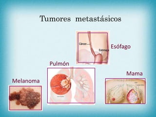 Tumores metastásicos
Pulmón
Esófago
Mama
Melanoma
 
