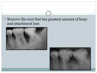  Remove the root that has greatest amount of bone
and attachment loss
 