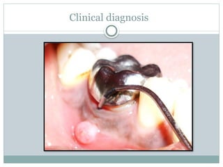 Clinical diagnosis
 