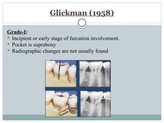 Glickman (1958)
Grade-I:
 Incipient or early stage of furcation involvement.
 Pocket is suprabony
 Radiographic changes are not usually found
 