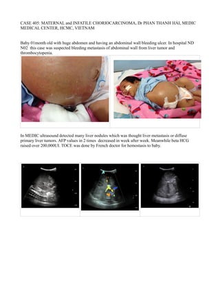 CASE 405: MATERNAL and INFATILE CHORIOCARCINOMA, Dr PHAN THANH HẢI, MEDIC
MEDICAL CENTER, HCMC, VIETNAM
Baby 01month old with huge abdomen and having an abdominal wall bleeding ulcer. In hospital ND
N02 this case was suspected bleeding metastasis of abdominal wall from liver tumor and
thrombocytopenia.
In MEDIC ultrasound detected many liver nodules which was thought liver metastasis or diffuse
primary liver tumors. AFP values in 2 times decreased in week after week. Meanwhile beta HCG
raised over 200,000UI. TOCE was done by French doctor for hemostasis to baby.
 