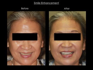 Before After
Smile Enhancement
 