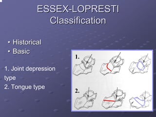 ESSEX-LOPRESTI
Classification
• Historical
• Basic
1. Joint depression
type
2. Tongue type

1.

2.

 