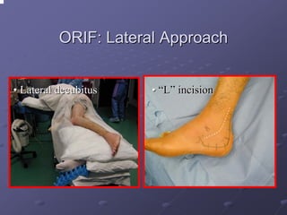 ORIF: Lateral Approach
• Lateral decubitus

• “L” incision

 