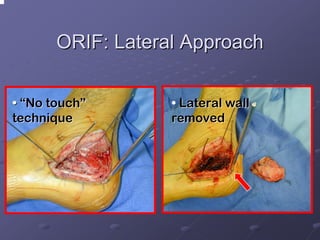 ORIF: Lateral Approach
• “No touch”
technique

• Lateral wall
removed

 