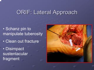 ORIF: Lateral Approach
• Schanz pin to
manipulate tuberosity
• Clean out fracture
• Disimpact
sustentacular
fragment

 