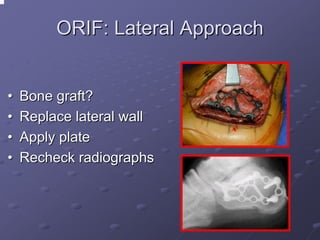 ORIF: Lateral Approach
•
•
•
•

Bone graft?
Replace lateral wall
Apply plate
Recheck radiographs

 