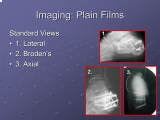 Imaging: Plain Films
Standard Views
• 1. Lateral
• 2. Broden’s
• 3. Axial

1.

2.

3.

 