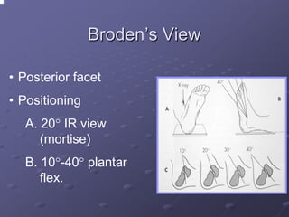 Broden’s View
• Posterior facet
• Positioning
A. 20° IR view
(mortise)
B. 10°-40° plantar
flex.

 