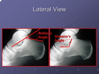 Lateral View

Bohler’s
Gissane’s
Angle
Angle

 