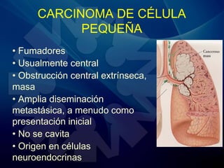 CARCINOMA DE CÉLULA
PEQUEÑA
• Fumadores
• Usualmente central
• Obstrucción central extrínseca,
masa
• Amplia diseminación
metastásica, a menudo como
presentación inicial
• No se cavita
• Origen en células
neuroendocrinas
 