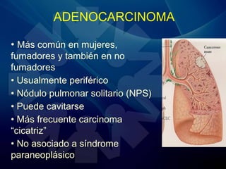 ADENOCARCINOMA
• Más común en mujeres,
fumadores y también en no
fumadores
• Usualmente periférico
• Nódulo pulmonar solitario (NPS)
• Puede cavitarse
• Más frecuente carcinoma
“cicatriz”
• No asociado a síndrome
paraneoplásico
 