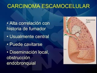CARCINOMA ESCAMOCELULAR
• Alta correlación con
historia de fumador
• Usualmente central
• Puede cavitarse
• Diseminación local,
obstrucción
endobronquial
 