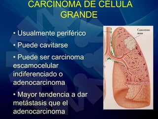CARCINOMA DE CÉLULA
GRANDE
• Usualmente periférico
• Puede cavitarse
• Puede ser carcinoma
escamocelular
indiferenciado o
adenocarcinoma
• Mayor tendencia a dar
metástasis que el
adenocarcinoma
 