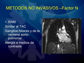 • RNM.
Similar al TAC
Ganglios hiliares y de la
ventana aorto-
pulmonar
Alergia a medios de
contraste
METODOS NO INVASIVOS –Factor N
 