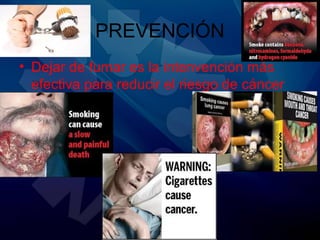 PREVENCIÓN
• Dejar de fumar es la intenvención más
efectiva para reducir el riesgo de cáncer
de pulmón.
 