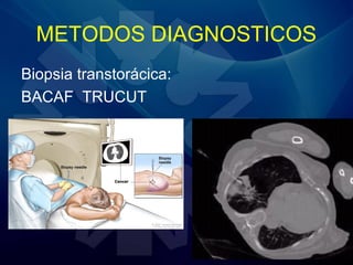 METODOS DIAGNOSTICOS
Biopsia transtorácica:
BACAF TRUCUT
 