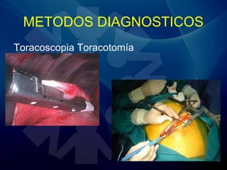 METODOS DIAGNOSTICOS
Toracoscopia Toracotomía
 