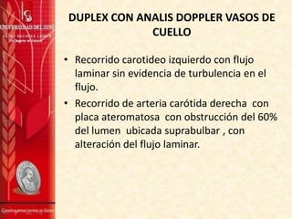 DUPLEX CON ANALIS DOPPLER VASOS DE
CUELLO
• Recorrido carotideo izquierdo con flujo
laminar sin evidencia de turbulencia en el
flujo.
• Recorrido de arteria carótida derecha con
placa ateromatosa con obstrucción del 60%
del lumen ubicada suprabulbar , con
alteración del flujo laminar.

 