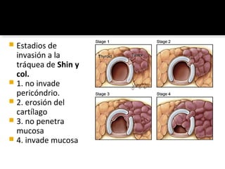  Estadios de
  invasión a la
  tráquea de Shin y
  col.
 1. no invade
  pericóndrio.
 2. erosión del
  cartílago
 3. no penetra
  mucosa
 4. invade mucosa
 