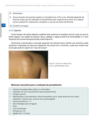 Ministério da Saúde | Secretaria de Atenção a Saúde | Departamento de Atenção Básica

8.	 Hemostasia.
9.	 Sutura da pele com pontos simples ou intradérmicos. O fio a ser utilizado depende do
local do corpo que foi realizado o procedimento (ver capítulo de sutura). Se o espaço
morto residual for importante, considerar o uso de um dreno de Penrose.

20

10.	Curativo com gaze.

2.2.2 Lipoma
Tumor benigno de células adiposas, podendo estar presente em qualquer área do corpo em que há
tecido adiposo: nas regiões do pescoço, dorso, nádegas e região proximal de extremidades. É o mais
frequente dos tumores benignos tecidos moles (Figura 4).
Geralmente é assintomático, mas pode apresentar dor discreta local e, devido a seu tamanho, pode
apresentar compressão de estruturas adjacentes. De acordo com o tamanho, a pele que recobre essa
tumoração pode ter aspecto de “casca de laranja”.

Figura 4 – Lipoma em região dorsal.
Fonte: (GOODTOKNOW, 2010).

Materiais necessários para a realização do procedimento
•	
•	
•	
•	
•	
•	
•	
•	
•	
•	

Solução de iodopovidina tópico ou clorexidina.
Lidocaína 1% sem vasoconstrictor para anestesia local.
Campos estéreis.
Material para o procedimento: pinça hemostática curva, pinça dente de rato, pinça
anatômica, tesoura reta, tesoura curva, porta-agulha.
Lâmina de bisturi nº 11.
Soro fisiológico para irrigação.
Gaze.
Luva esterilizada.
Seringa de 5 ml.
Agulha 40 x 12 (rosa).

 
