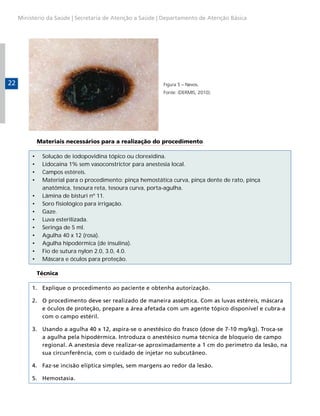 Ministério da Saúde | Secretaria de Atenção a Saúde | Departamento de Atenção Básica

22

Figura 5 – Nevos.
Fonte: (DERMIS, 2010).

Materiais necessários para a realização do procedimento
•	
•	
•	
•	
•	
•	
•	
•	
•	
•	
•	
•	
•	

Solução de iodopovidina tópico ou clorexidina.
Lidocaína 1% sem vasoconstrictor para anestesia local.
Campos estéreis.
Material para o procedimento: pinça hemostática curva, pinça dente de rato, pinça
anatômica, tesoura reta, tesoura curva, porta-agulha.
Lâmina de bisturi nº 11.
Soro fisiológico para irrigação.
Gaze.
Luva esterilizada.
Seringa de 5 ml.
Agulha 40 x 12 (rosa).
Agulha hipodérmica (de insulina).
Fio de sutura nylon 2.0, 3.0, 4.0.
Máscara e óculos para proteção.
Técnica

1.	 Explique o procedimento ao paciente e obtenha autorização.
2.	 O procedimento deve ser realizado de maneira asséptica. Com as luvas estéreis, máscara
e óculos de proteção, prepare a área afetada com um agente tópico disponível e cubra-a
com o campo estéril.
3.	 Usando a agulha 40 x 12, aspira-se o anestésico do frasco (dose de 7-10 mg/kg). Troca-se
a agulha pela hipodérmica. Introduza o anestésico numa técnica de bloqueio de campo
regional. A anestesia deve realizar-se aproximadamente a 1 cm do perímetro da lesão, na
sua circunferência, com o cuidado de injetar no subcutâneo.
4.	 Faz-se incisão elíptica simples, sem margens ao redor da lesão.
5.	 Hemostasia.

 