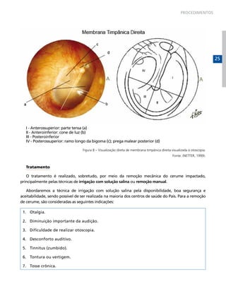 PROCEDIMENTOS

25

I - Anterossuperior: parte tensa (a)
II - Anteroinferior: cone de luz (b)
III - Posteroinferior
IV - Posterossuperior: ramo longo da bigoma (c); prega malear posterior (d)
Figura 8 – Visualização direta de membrana timpânica direita visualizada à otoscopia.
Fonte: (NETTER, 1999).

Tratamento
O tratamento é realizado, sobretudo, por meio da remoção mecânica do cerume impactado,
principalmente pelas técnicas de irrigação com solução salina ou remoção manual.
Abordaremos a técnica de irrigação com solução salina pela disponibilidade, boa segurança e
aceitabilidade, sendo possível de ser realizada na maioria dos centros de saúde do País. Para a remoção
de cerume, são consideradas as seguintes indicações:
1.	 Otalgia.
2.	 Diminuição importante da audição.
3.	 Dificuldade de realizar otoscopia.
4.	 Desconforto auditivo.
5.	 Tinnitus (zumbido).
6.	 Tontura ou vertigem.
7.	 Tosse crônica.

 