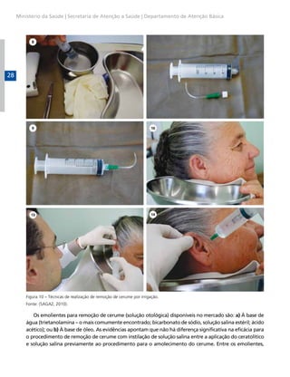 Ministério da Saúde | Secretaria de Atenção a Saúde | Departamento de Atenção Básica

28

Figura 10 – Técnicas de realização de remoção de cerume por irrigação.
Fonte: (SAGAZ, 2010).

Os emolientes para remoção de cerume (solução otológica) disponíveis no mercado são: a) À base de
água (trietanolamina – o mais comumente encontrado; bicarbonato de sódio, solução salina estéril; ácido
acético); ou b) À base de óleo. As evidências apontam que não há diferença significativa na eficácia para
o procedimento de remoção de cerume com instilação de solução salina entre a aplicação do ceratolítico
e solução salina previamente ao procedimento para o amolecimento do cerume. Entre os emolientes,

 