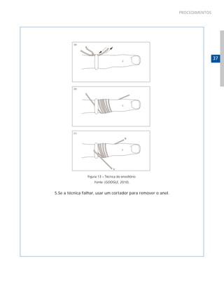 PROCEDIMENTOS

37

Figura 13 – Técnica do envoltório.
Fonte: (GOOGLE, 2010).

5.Se a técnica falhar, usar um cortador para remover o anel.

 