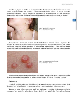 PROCEDIMENTOS

Na infância, o pico de incidência situa-se entre 3 e 10 anos e as pápulas localizam-se na face,
tronco ou extremidades. Em adultos, a transmissão costuma ser sexual e as lesões, portanto,
geralmente limitadas à região anogenital. A presença de lesões múltiplas na face, pescoço ou
disseminadas em adultos sugere imunossupressão, devendo se atentar para infecção pelo HIV.

39

Figura 14 – Molusco contagioso.
Fonte: (INFANCIAHOY, 2010).

O diagnóstico é clínico com base no aspecto da lesão e do material obtido à expressão das
pápulas. As lesões características do molusco contagioso são pápulas semiesféricas com centro
umbilicado, peroladas, róseas ou da cor da própria pele, medindo de 3 a 6 mm, isoladas e bem
delimitadas. São facilmente removíveis, eliminando material esbranquiçado com partículas virais.

Figura 15 – Molusco contagioso (close).
Fonte: (WIKIPÉDIA, [2010]).

Usualmente as lesões são assintomáticas, mas podem apresentar eczema e prurido ao redor
delas. A procura à Unidade Básica de Saúde costuma ser em função do incômodo estético.
Tratamento
Em geral, nos indivíduos imunocompetentes, as lesões involuem espontaneamente em um a
dois anos, não se justificando tratamentos mais agressivos que possam deixar cicatrizes.
Quando se opta pelo tratamento, pode ser realizada a remoção mecânica por meio da
curetagem com posterior aplicação de tintura de iodo em cada lesão. Alternativas eficazes,

 