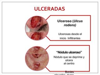 Ulcus Rodems Ca basocelular | PPTX
