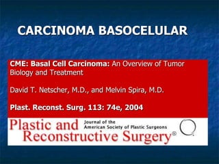 CARCINOMA BASOCELULAR
CME: Basal Cell Carcinoma: An Overview of Tumor
Biology and Treatment
David T. Netscher, M.D., and Melvin Spira, M.D.
Plast. Reconst. Surg. 113: 74e, 2004
 