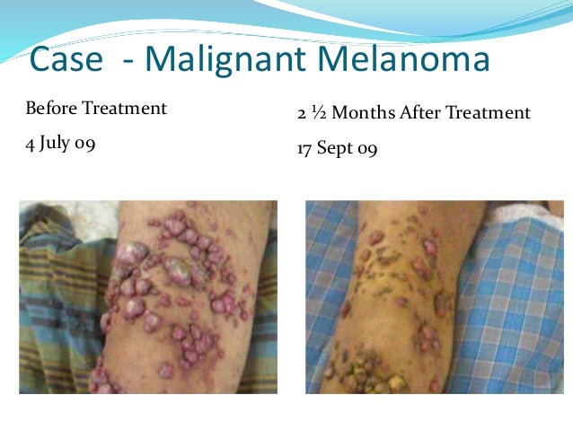 What is the prognosis for melanoma?