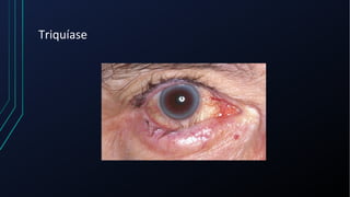 Triquíase
 