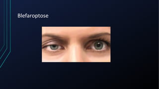Blefaroptose
 
