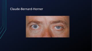 Claude-Bernard-Horner
 