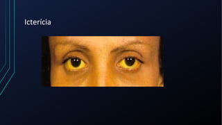 Icterícia
 