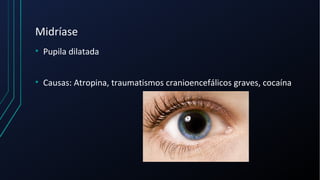 Midríase
• Pupila dilatada
• Causas: Atropina, traumatismos cranioencefálicos graves, cocaína
 