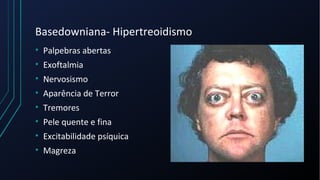 Basedowniana- Hipertreoidismo
• Palpebras abertas
• Exoftalmia
• Nervosismo
• Aparência de Terror
• Tremores
• Pele quente e fina
• Excitabilidade psíquica
• Magreza
 