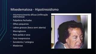 Mixedematosa - Hipotireoidismo
• Intumenscimento difuso (infiltração
edematosa)
• Palpebras fechadas
• Olhos pequenos
• Labios grossos (boca semi aberta)
• Macroglossia
• Pele palida e seca
• Face inexpressiva
• Sonolenta / Letárgica
• Madarose
 