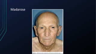 Madarose
 