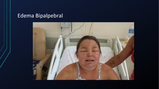 Edema Bipalpebral
 