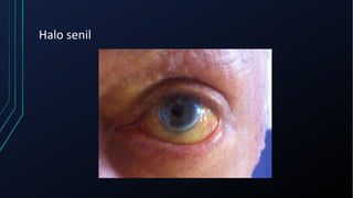 Halo senil
 
