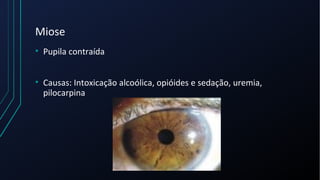 Miose
• Pupila contraída
• Causas: Intoxicação alcoólica, opióides e sedação, uremia,
pilocarpina
 
